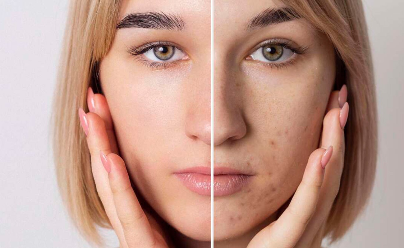 Hyper-Pigmentation-Reduction