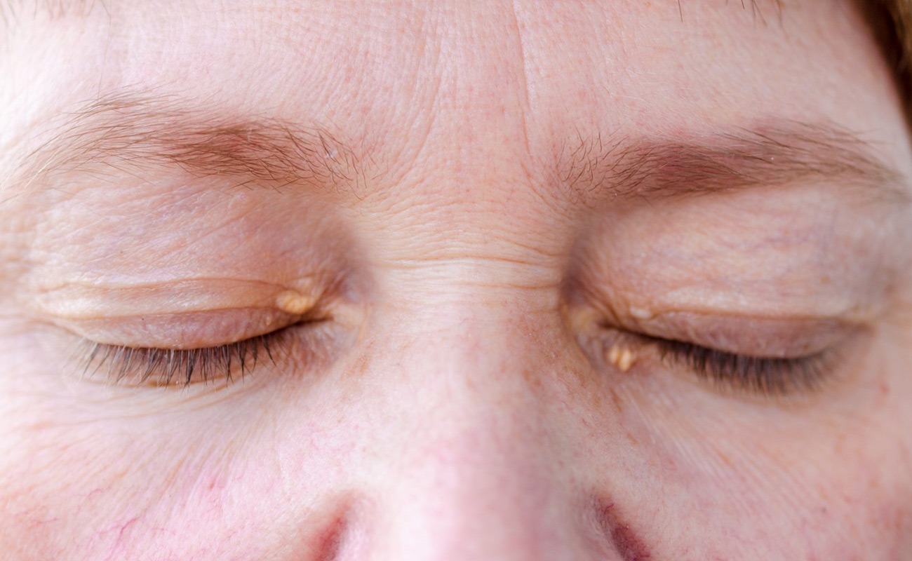 Xanthelasma